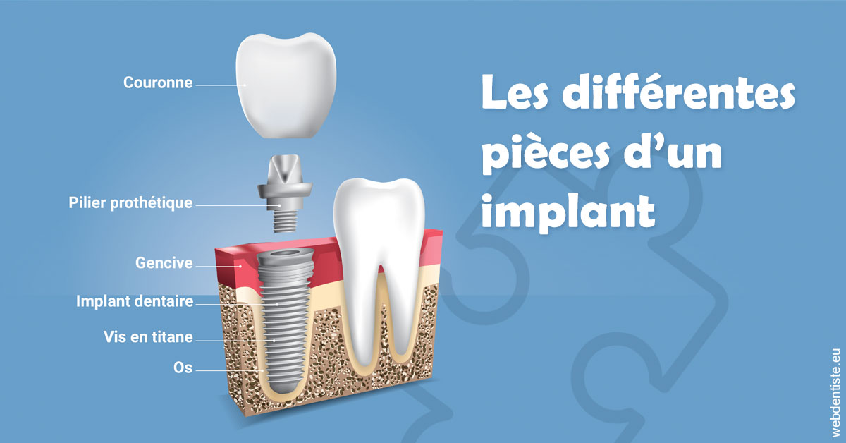 https://www.cbsorthodontie.lu/Les différentes pièces d’un implant 1